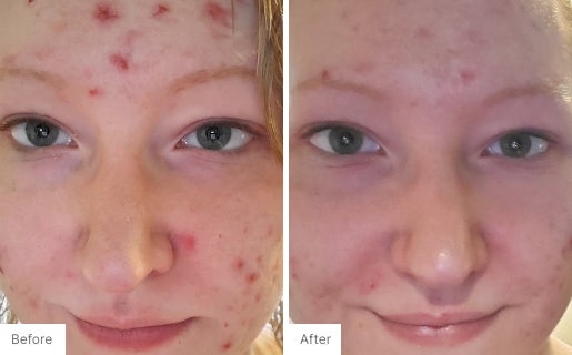 Acne Real Results Image 2